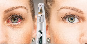 NuLids Eyelid treatment